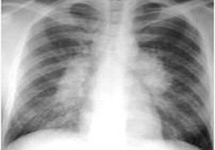 chest-xray